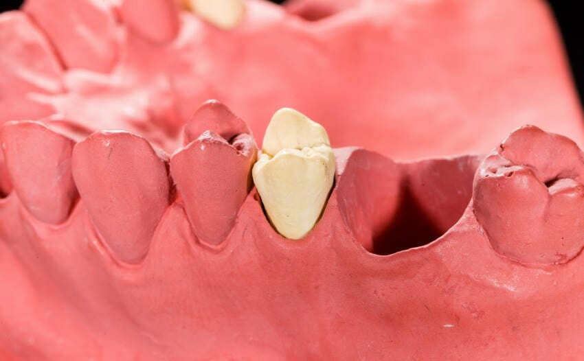 What Is a Socket Preservation Graft Dr. Kyle Hornby, Kitchener Dentist