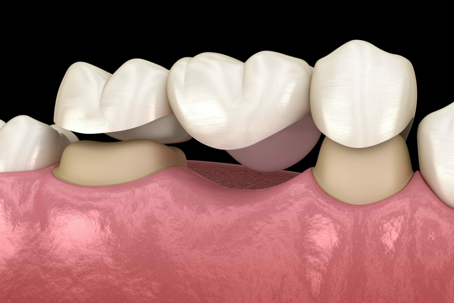 Kitchener Dentist Files: Implant or Dental Bridge? (Part 1) – Enamel