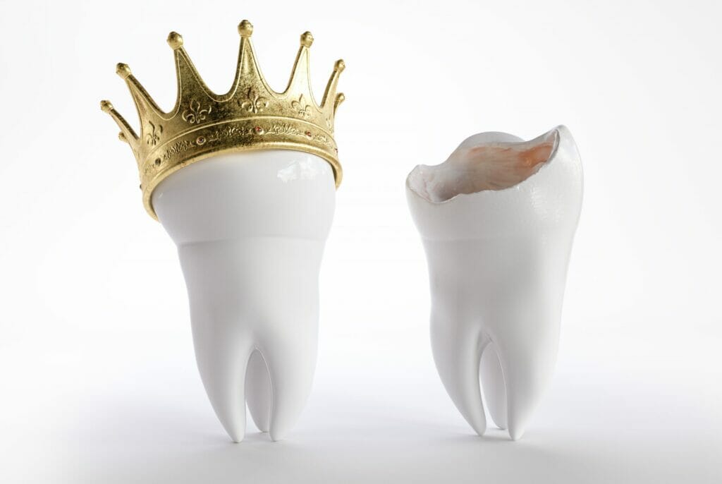 What is Crown Lengthening and how much does it cost? ENAMEL REPUBLIC
