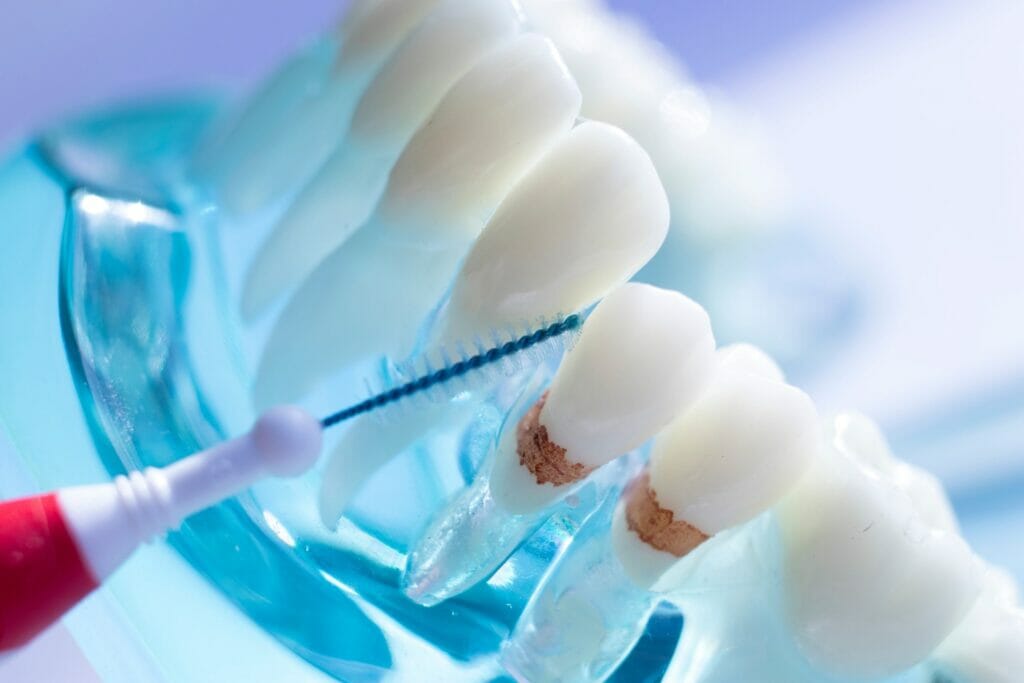 How to Manage Food Traps Between Your Teeth ? Enamel Republic