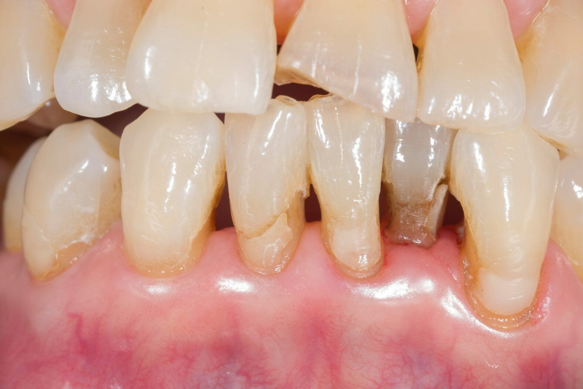 a-rational-approach-to-managing-gum-recession-enamel-republic