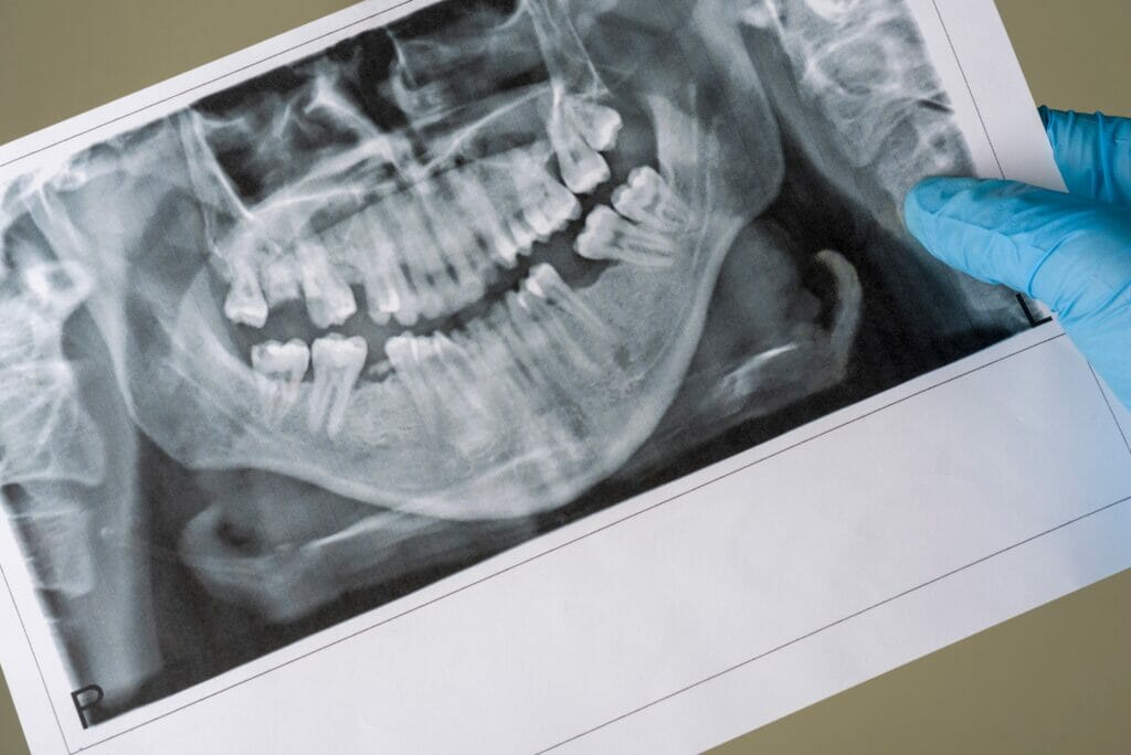 Can Dental Bone Loss Be Reversed Enamel Republic